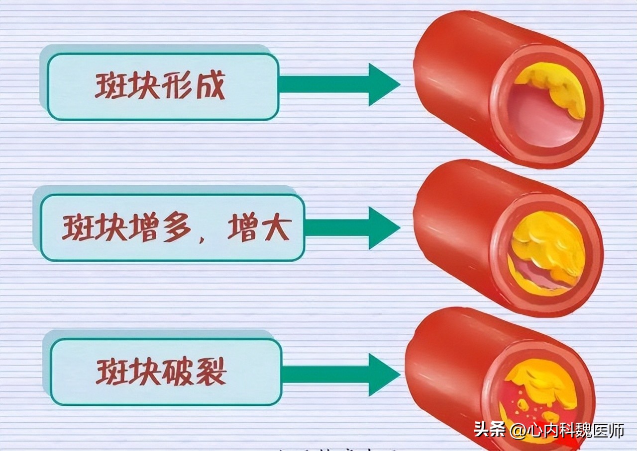 高血压的人低压低是怎么回事,高血压低压超过90低于100