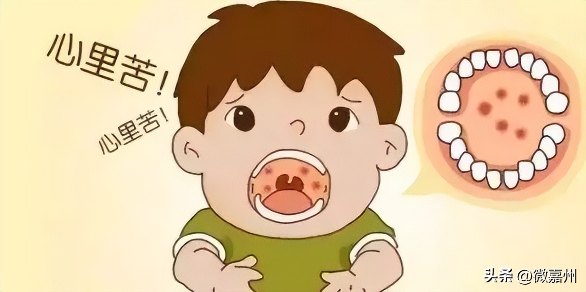 手足口病与疱疹性咽峡炎鉴别点,手足口疱疹性咽峡炎吃什么药