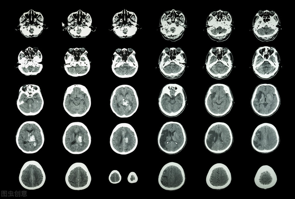 脑卒中的康复治疗工作,脑卒中患者康复查体