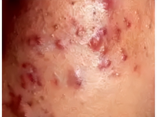 痘痘怎么护理和消除,痘痘怎么自然养好