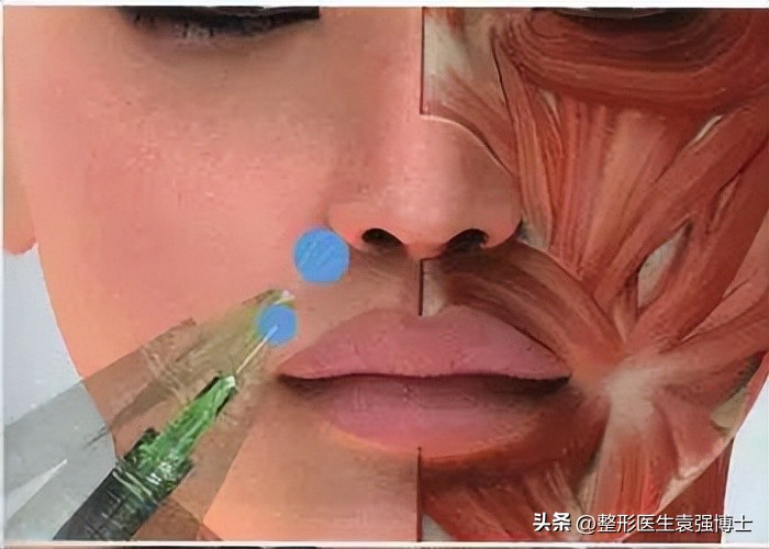 法令纹用药膏能去除吗,法令纹可以消除吗医美