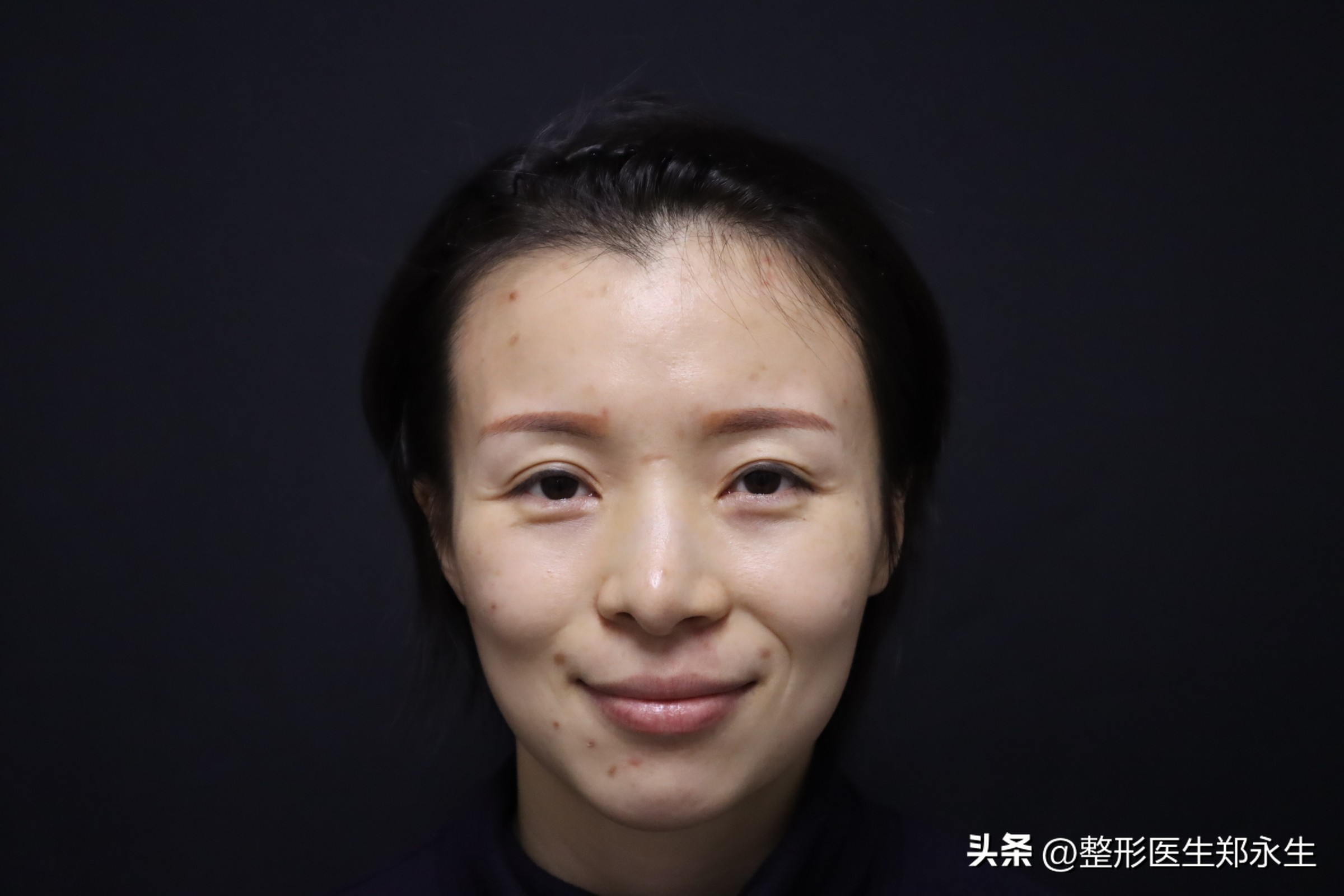 隆鼻后变朝天鼻修复成功案例,关于隆鼻失败