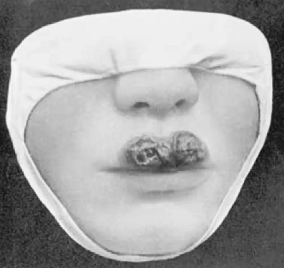 古代中医能治梅毒吗,古代人治梅毒有多奇葩