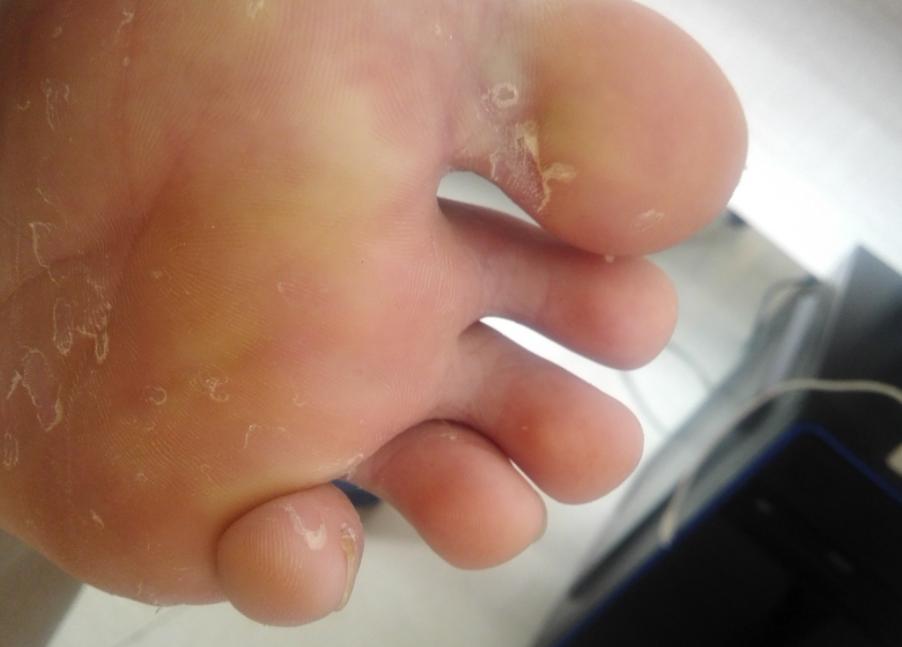 脚气真菌怎么治才能除根,脚气真菌怎么彻底消灭