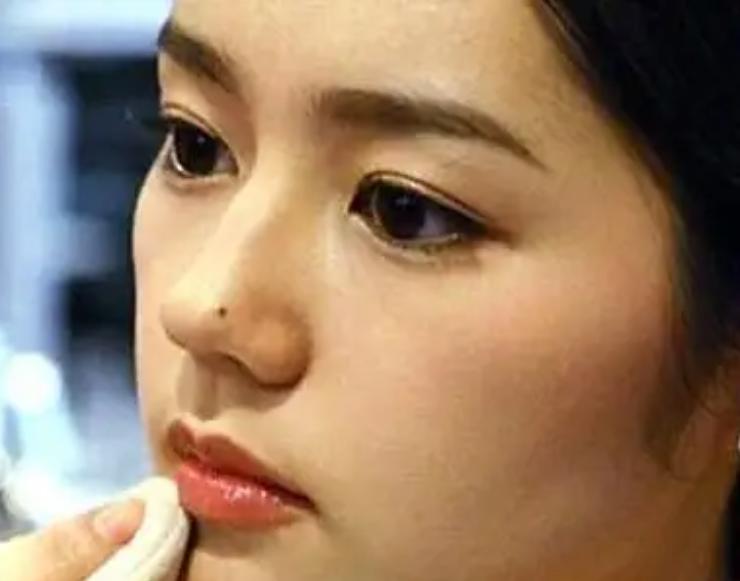 黑痣发生这些变化时要警惕,医生长在摩擦部位的黑痣要当心