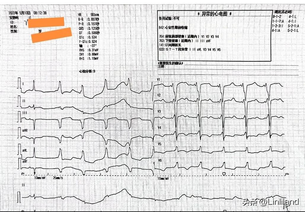 过速性房颤治疗,持续性房颤心动过速