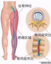 怎么治疗腰间盘突出压迫的神经痛,造成腰间盘突出原因及医治方法