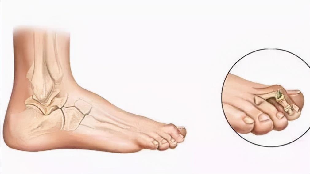 大拇脚趾外翻用什么矫正方法,大脚趾外翻歪怎么办