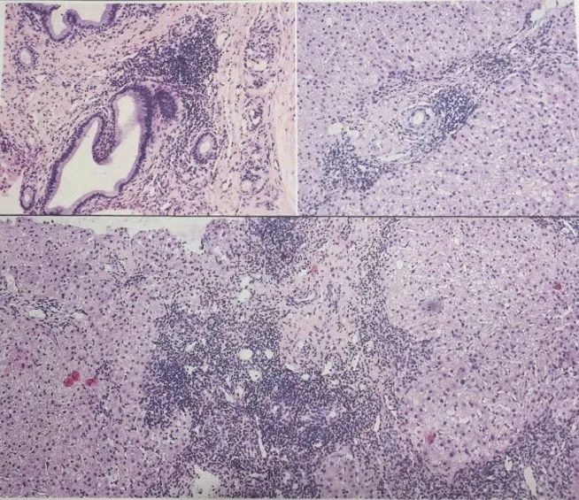 黄疸胆红素反复升高怎么回事,黄疸会导致谷草转氨酶升高吗