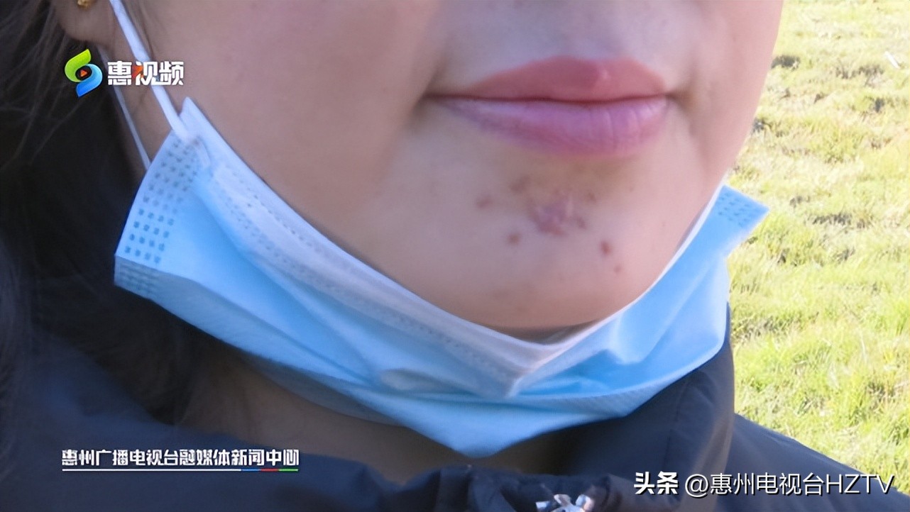 女子做扁平疣被美容院骗10万后续,美容院点扁平疣造成疤痕增生赔偿