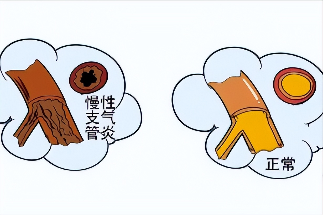 儿童急性支气管炎和急性鼻炎症状,急性支气管炎的症状和表现