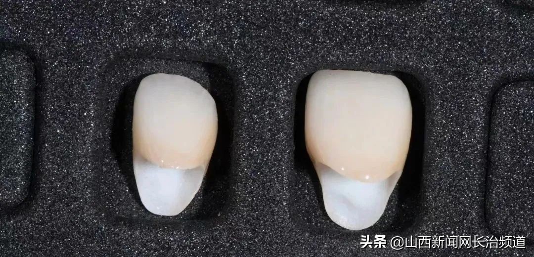 门牙牙齿摔断了一半怎么处理,长治二院医生牙齿掉了怎么办