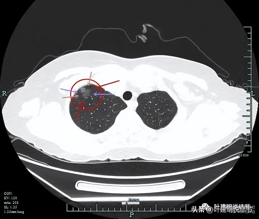 肺癌病理的肿块是硬的吗,肺癌病灶什么样