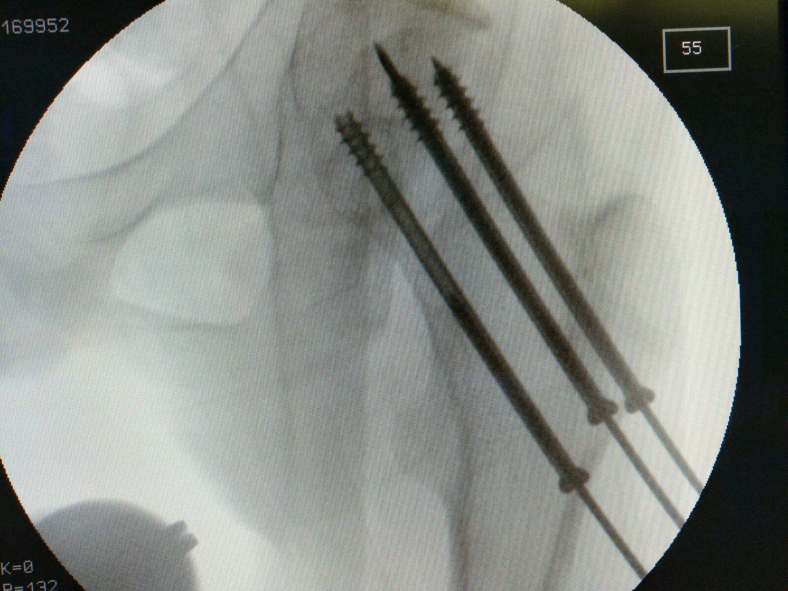 股骨颈骨折矫正仪器,骨科机器人好用吗
