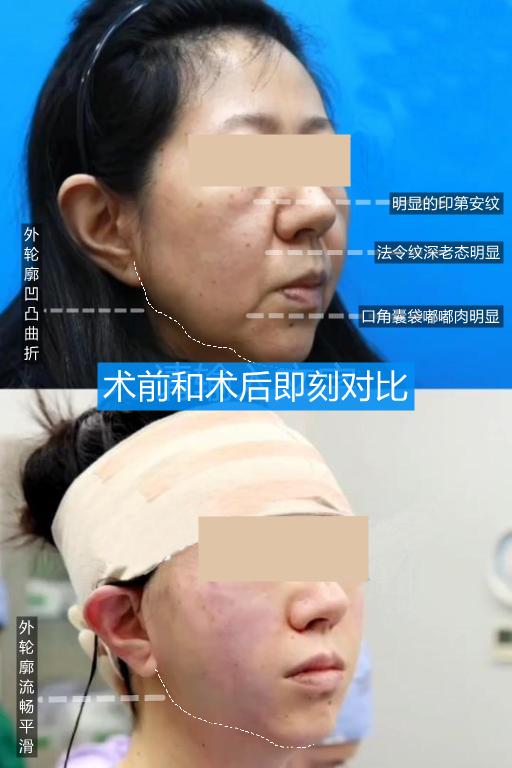 轮廓线打造和吸脂,面部轮廓线吸脂