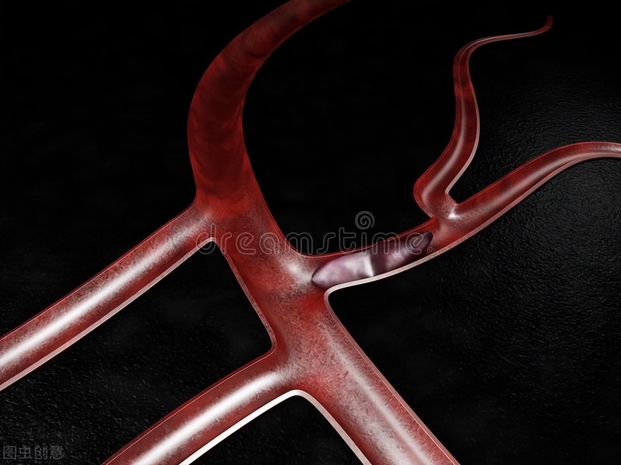 肝硬化门静脉血栓治疗共识,肝硬化门静脉血栓的最佳治疗方案