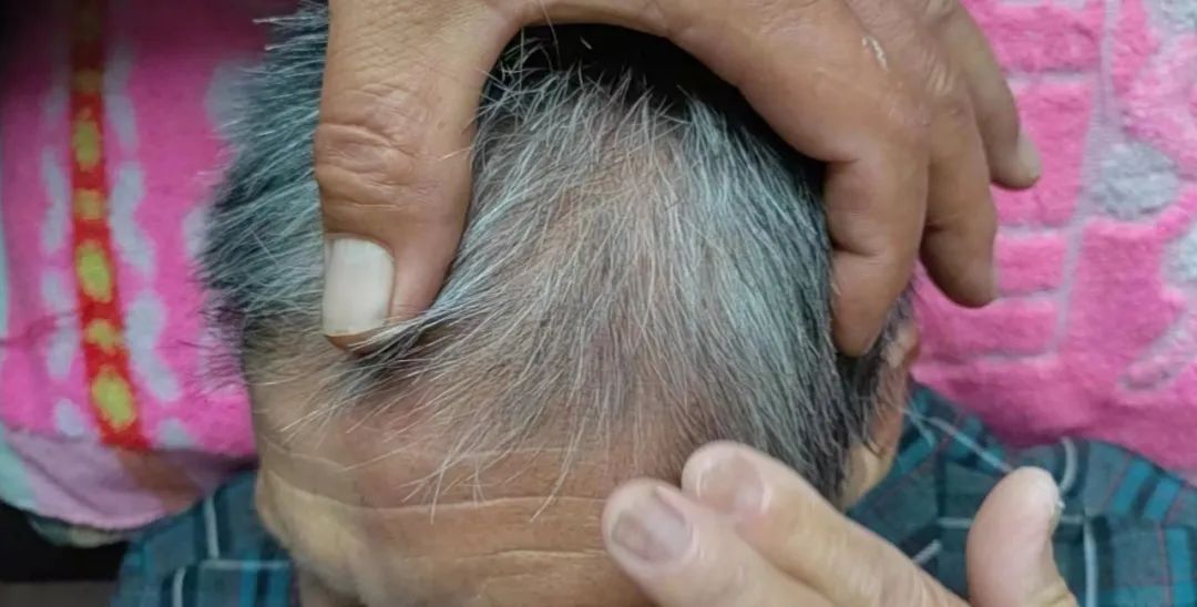 消失的疱疹，难忍的疼痛