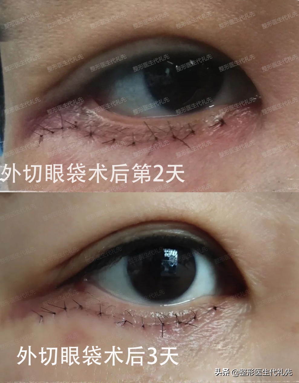 外切眼袋手术警惕三大后遗症,外切眼袋手术后多长时间恢复正常