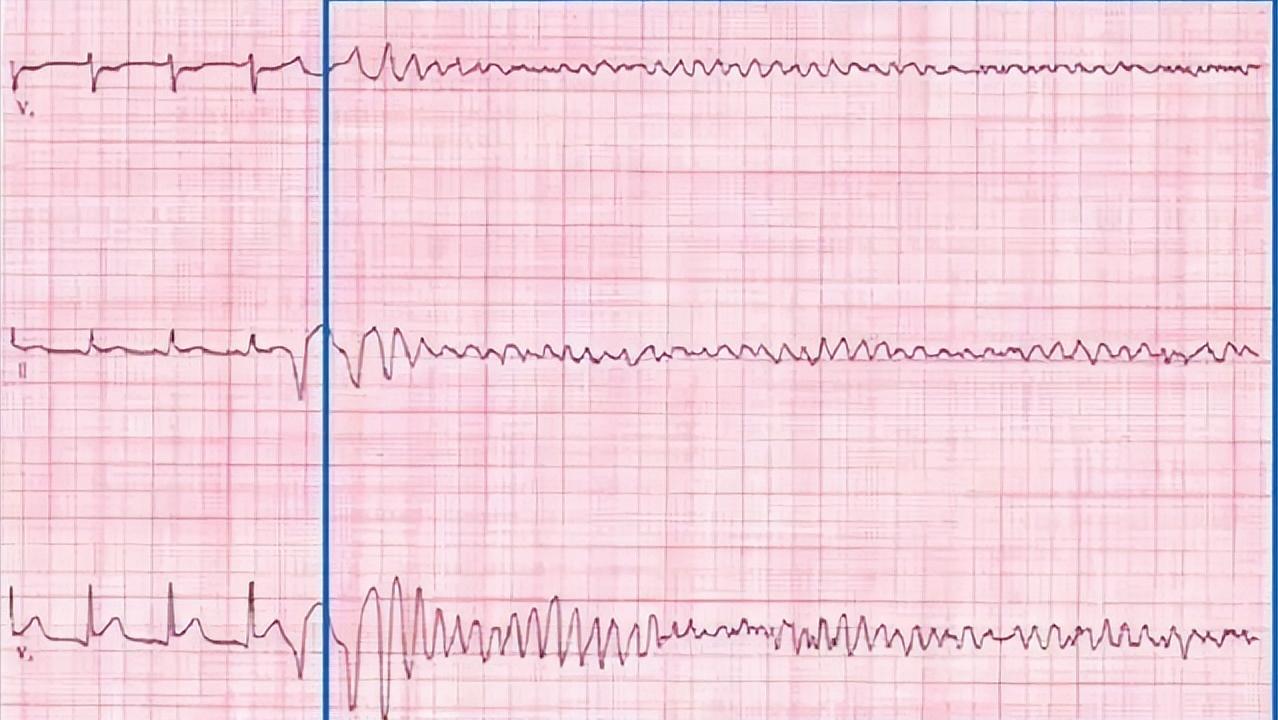 小伙查出尿毒症痛哭,男子查出肾衰竭
