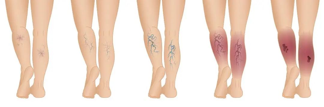 比微创介入更高级的手术,血管万能胶