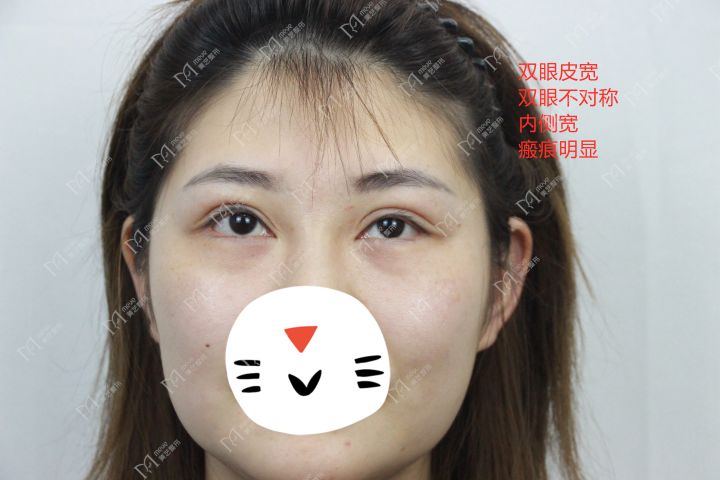 割双眼皮是属于整形还是美容,割双眼皮就是整容吗