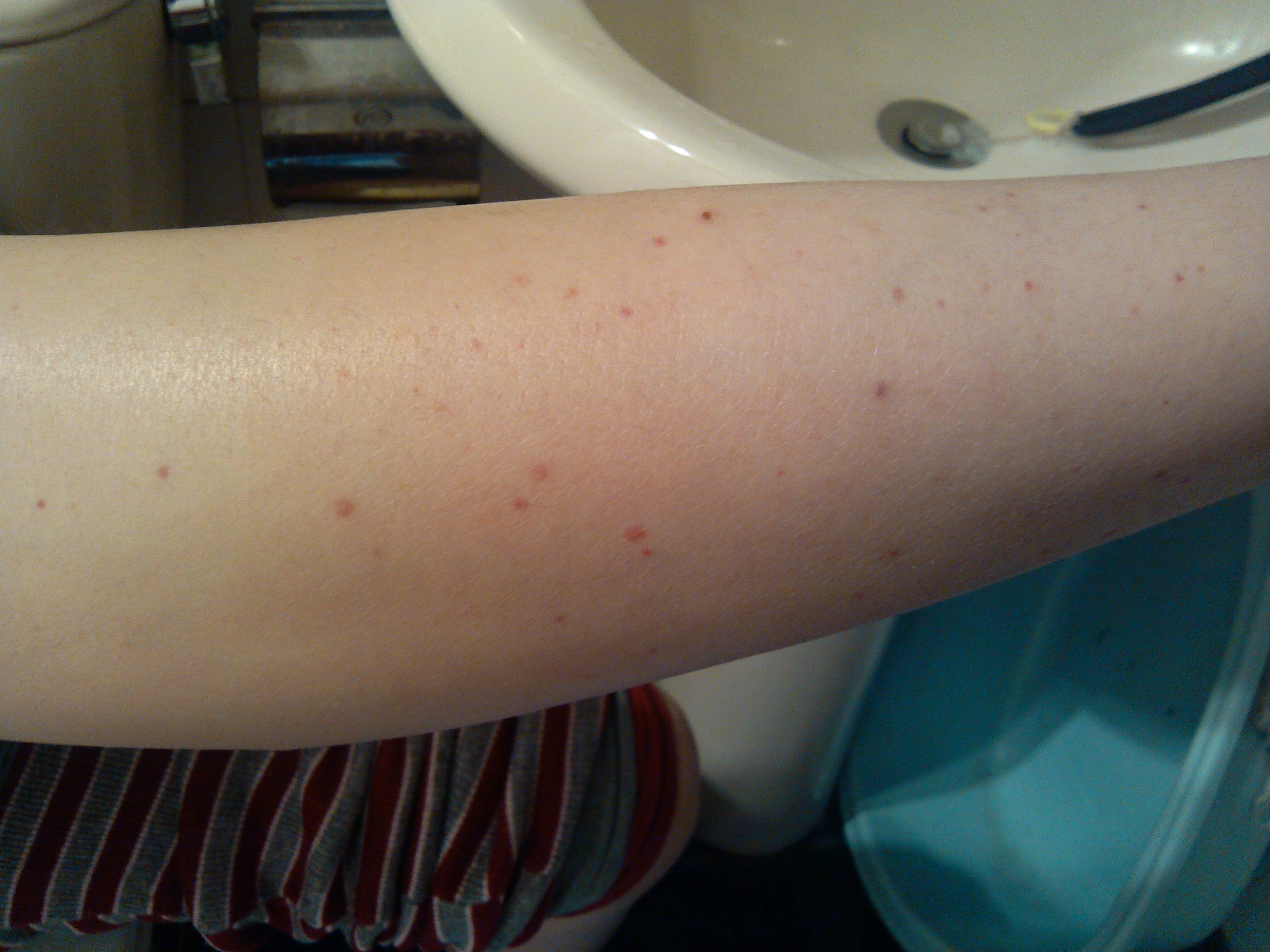 13岁男孩急性阑尾炎,腹型紫癜误诊为阑尾炎