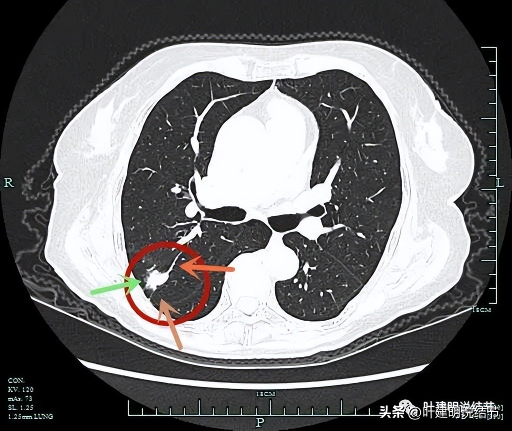 79岁肺癌早期手术风险,75岁早期浸润性肺癌还要治疗吗