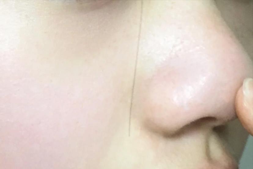 甲硝唑和壬二酸正确时间使用方法,甲硝唑和壬二酸要洗掉吗