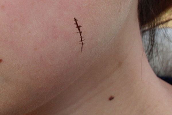 什么情况伤口需打破伤风,一般怎样的伤口需要打破伤风