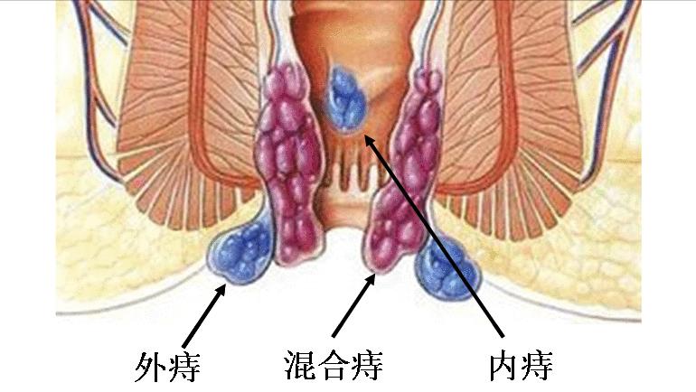 24岁女生肛裂正常吗,16岁女孩经常肛裂怎么治疗