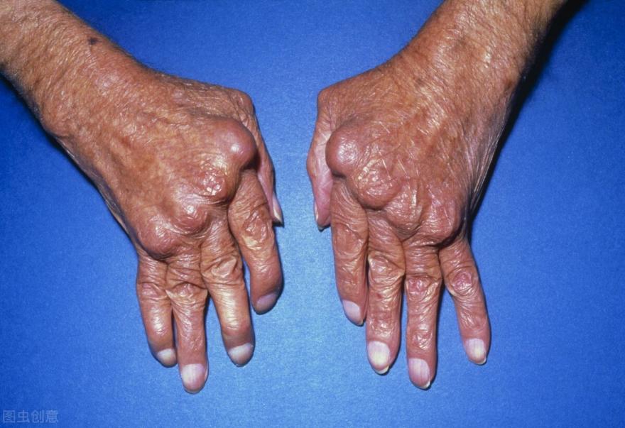 关节炎为什么越活动越厉害,类风湿性关节炎寿命的影响