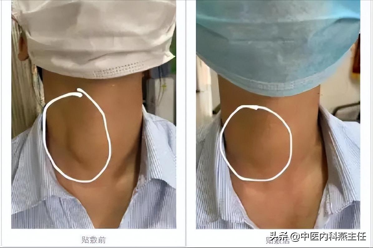 桥本甲状腺炎甲亢结节有什么药,甲状腺炎甲状腺结节甲亢咋治疗