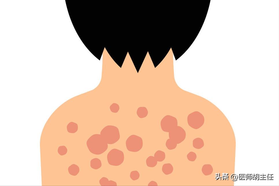 带状疱疹缠腰蛇为什么会头痛,蛇缠腰带状疱疹怎么才算治好