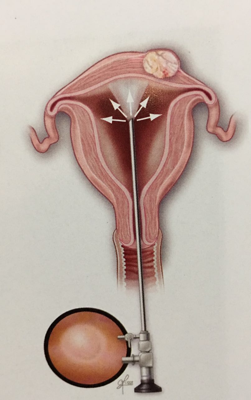 【科普】子宫内膜癌有两种类型，你了解吗？腹腔镜手术效果如何？