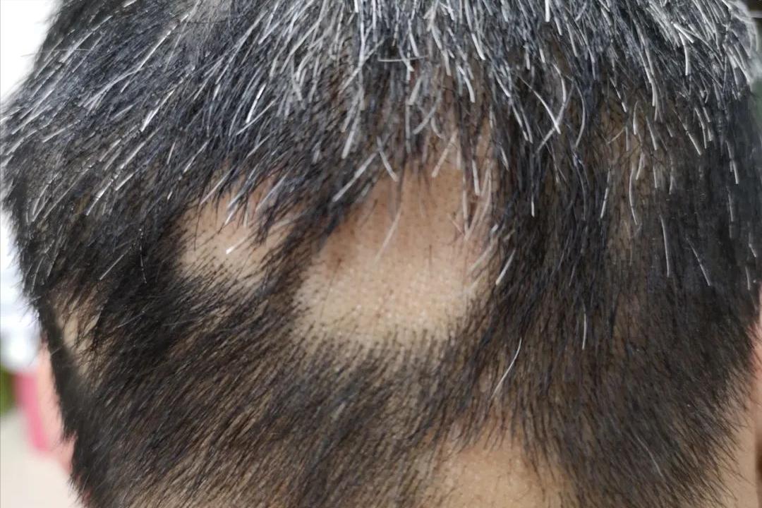 头屑多脱发怎么去除小妙招,头屑如何调理生发最有效