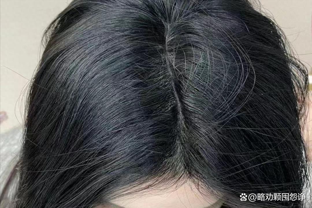 不用花钱就能快速消除头屑,解决脱发不用洗发水