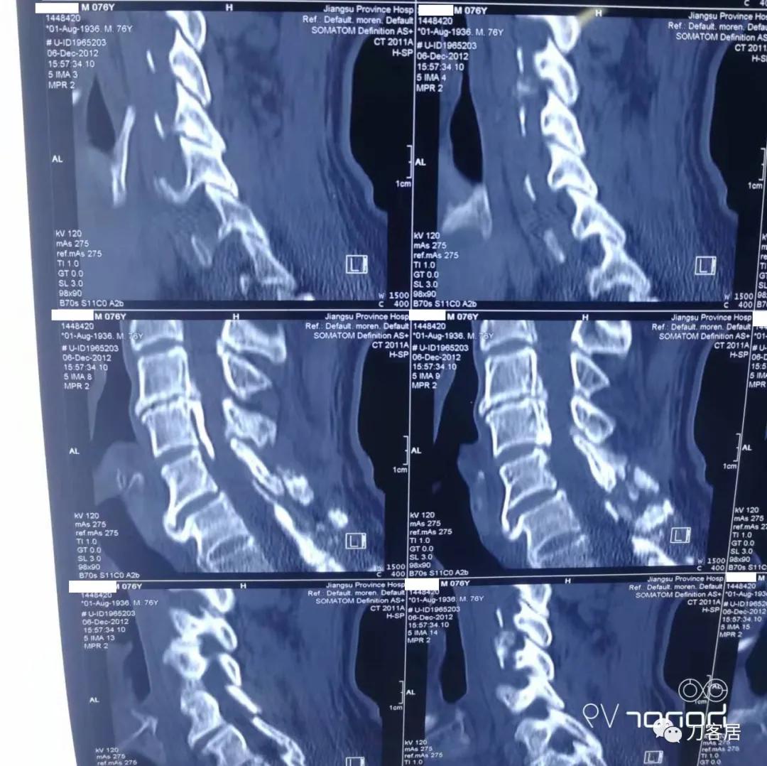 颈椎椎管内肿瘤手术20例麻醉处理,颈椎脊髓内肿瘤手术成功案例