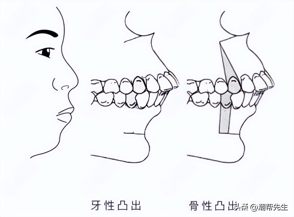 如何辨别唇性嘴凸和齿性嘴凸,女士嘴三分龅真的好看吗