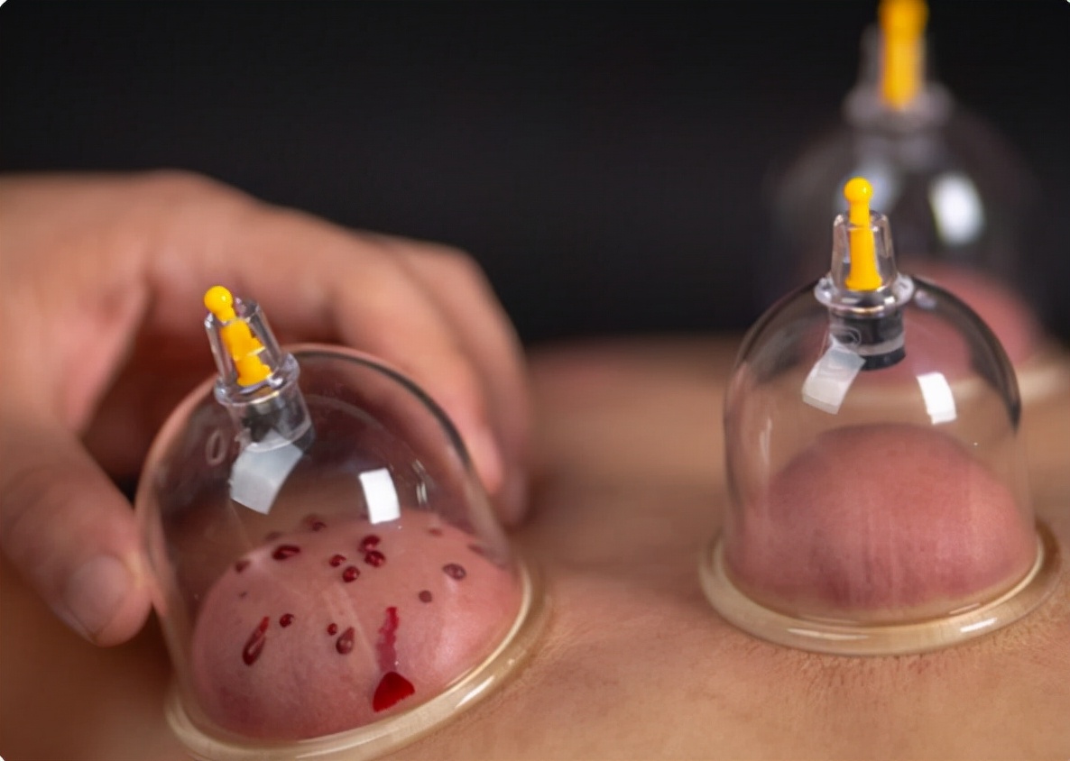 拔火罐时，后背吸出的瘀血，真的是毒素吗？来听听医生的答案