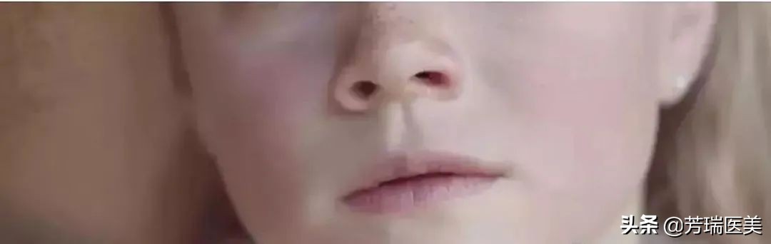 雀斑是怎么晒出来的,雀斑是怎么形成的过程