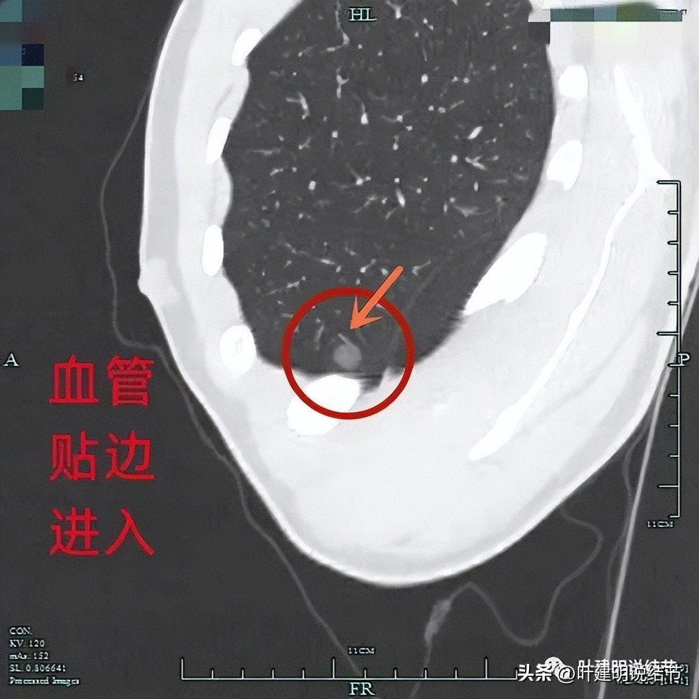 中叶多发微小结节,男性30岁右侧甲状腺单发结节