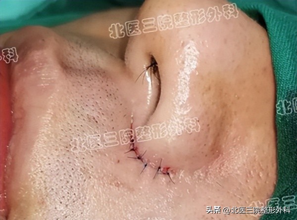 鼻翼切痣容易留疤么,鼻翼旁的痣怎么切除