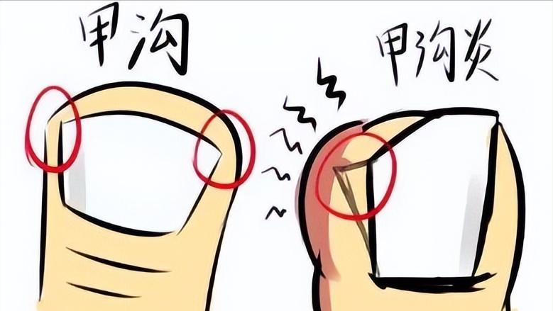 撕指甲引起甲沟炎怎么办,指甲倒刺别乱撕