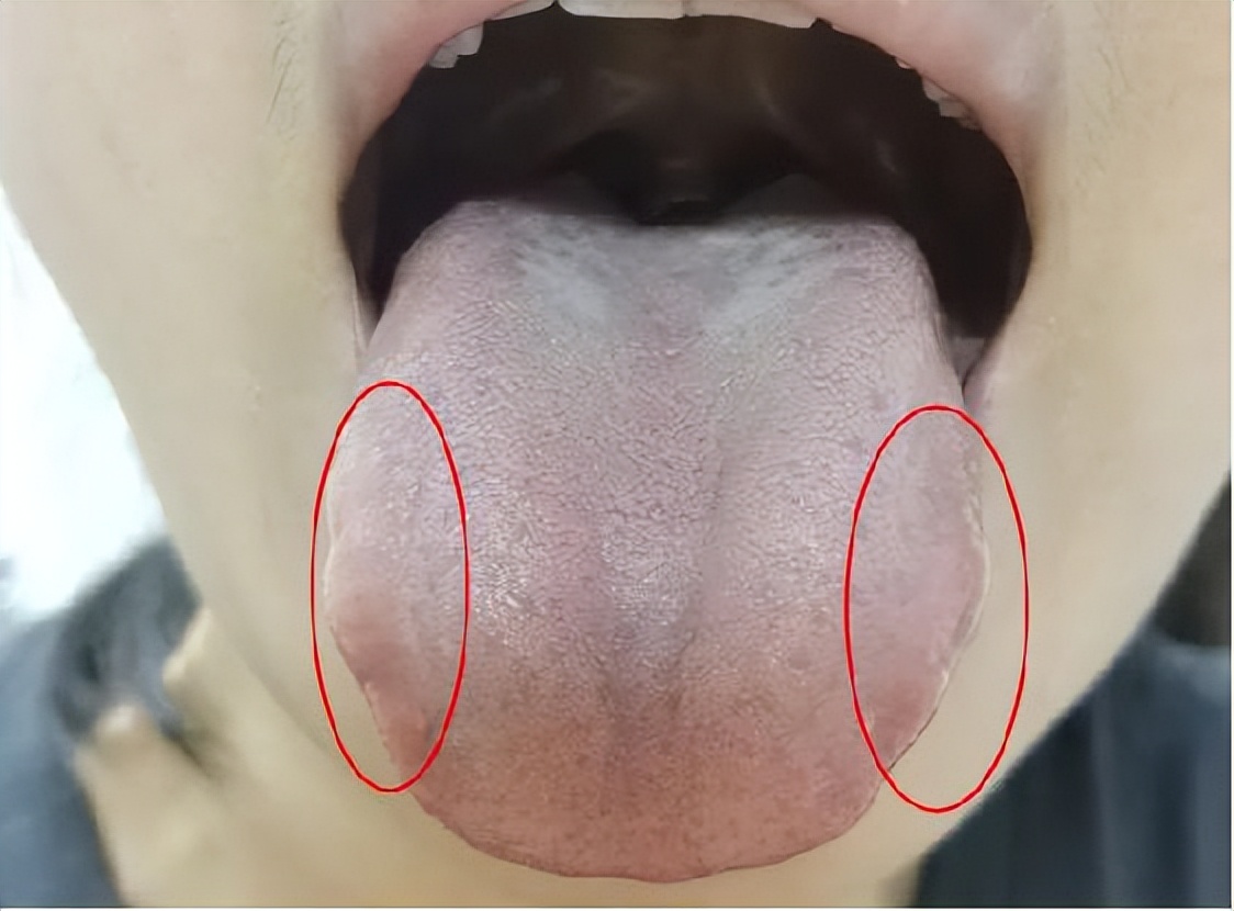 慢性咽炎咽干有异物感怎么治疗,咽喉炎咽干咽痛异物感怎么办