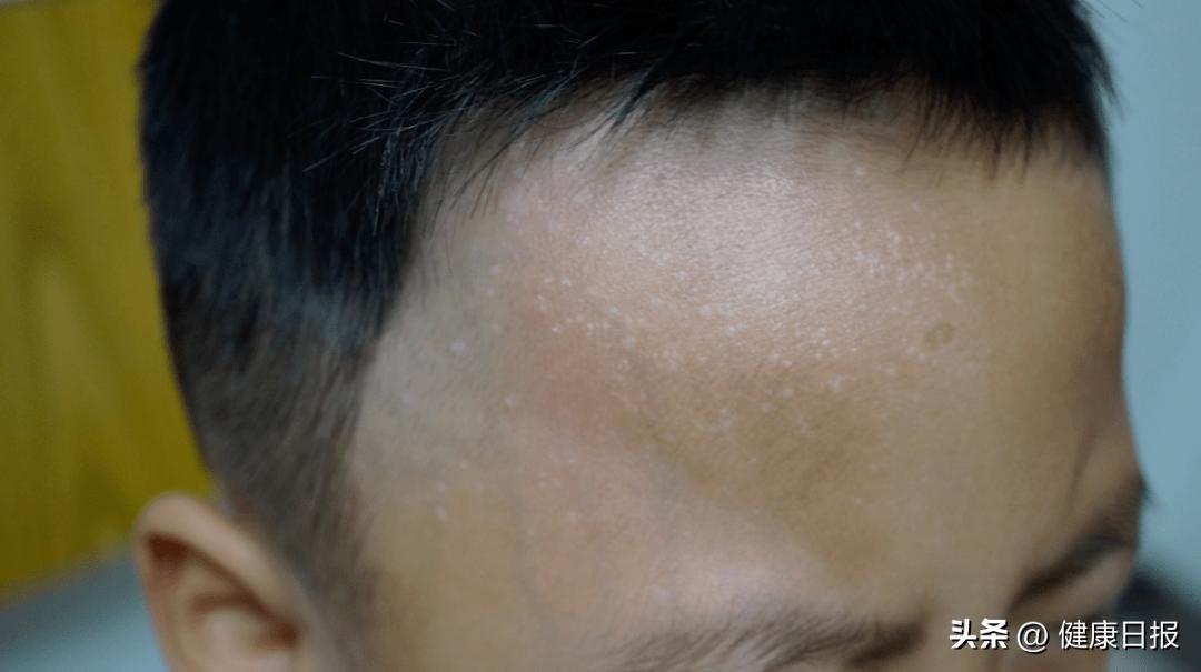 宝宝脖子有白色的圆点,宝宝皮肤上白色圆圈