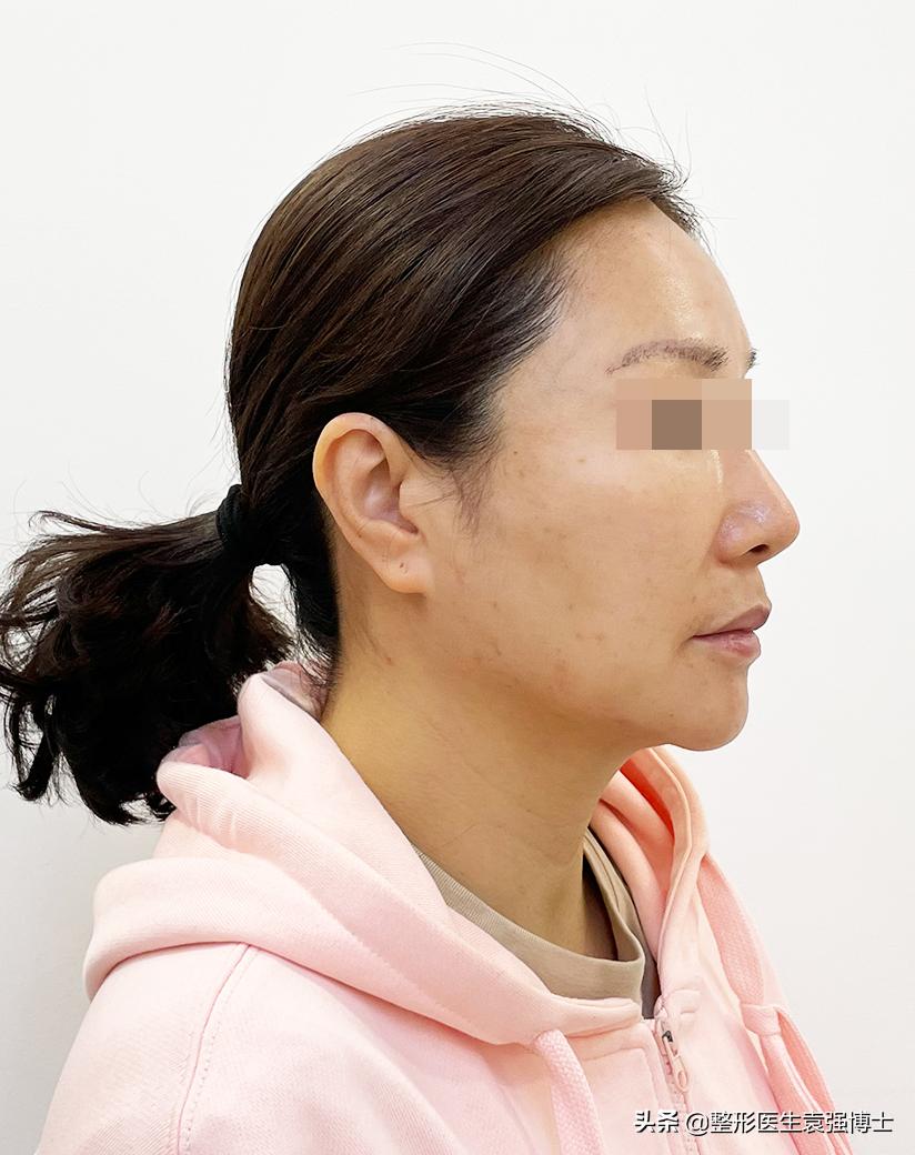 小拉皮能改善下颌线吗,拉皮手术改善下颌线