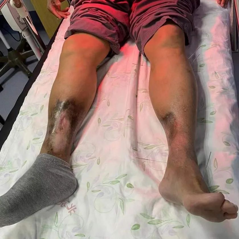 多科室合作救治,多管齐下抗击病魔