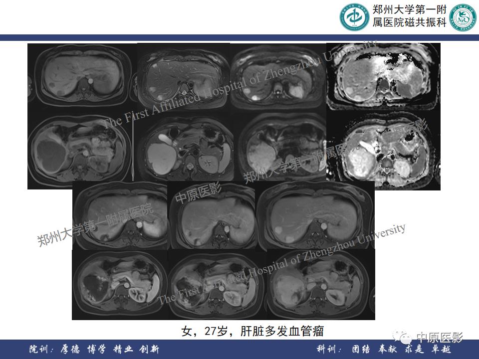 肝脏血管瘤样本,正确认识肝脏血管瘤文章