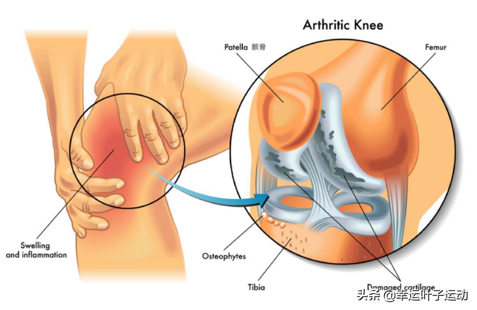 跑步膝盖痛的最快治疗方法,学会这几招跑步很轻松