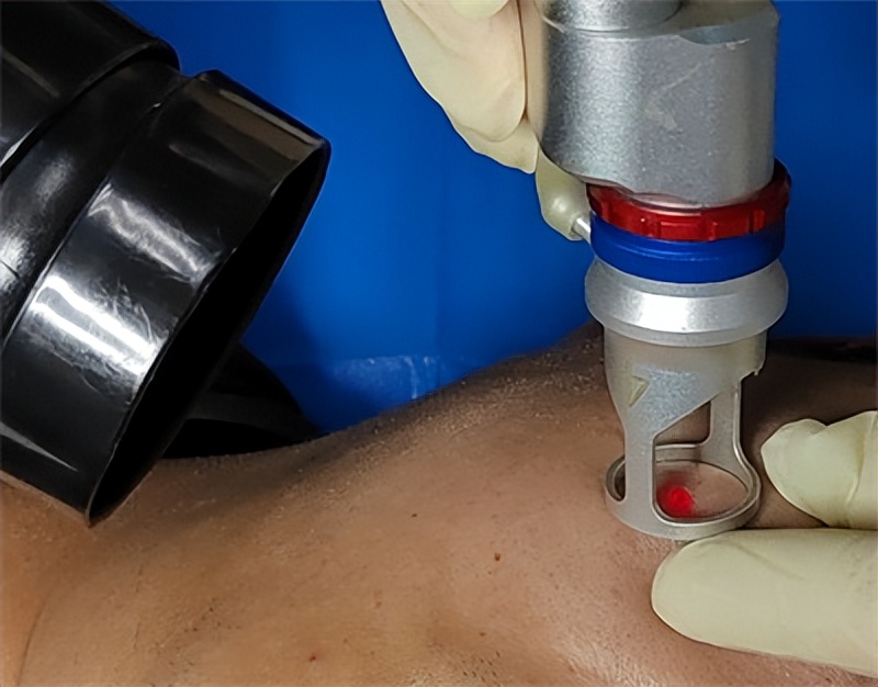 脸上的痣可以点掉吗,脸上有痣激光去痣好还是药水点好